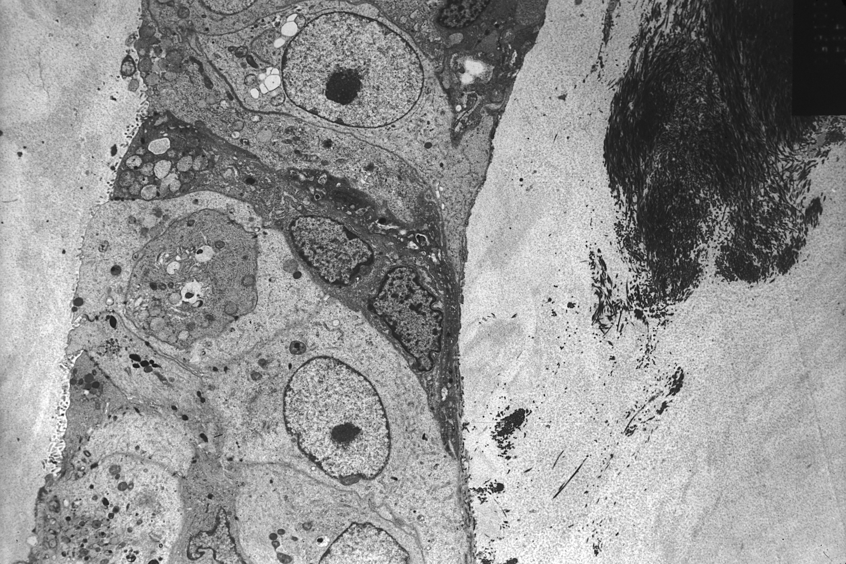 A grayscale electron microscope image of a breast cancer cell.