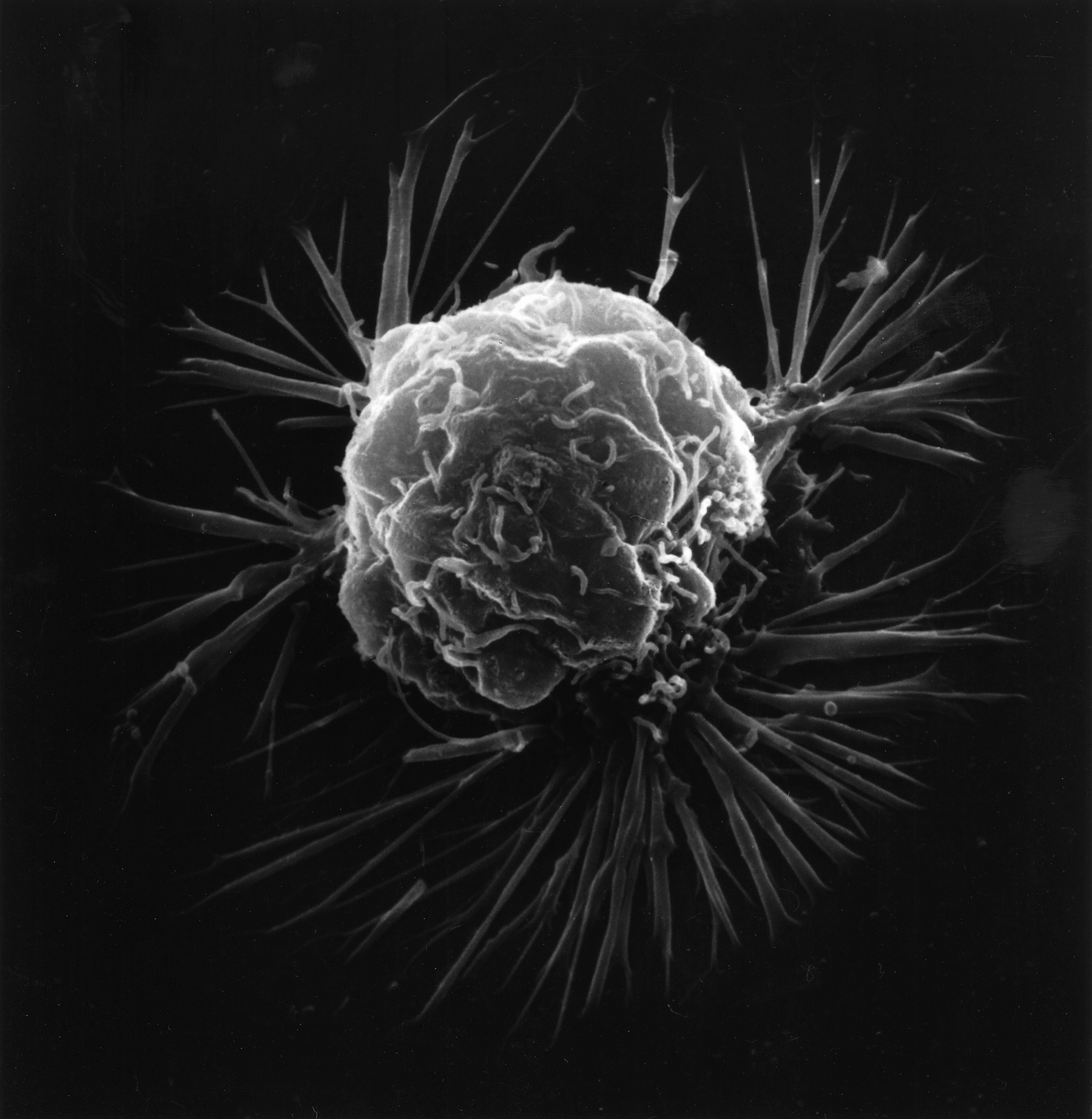 A grayscale scanning electron microscope image of a breast cancer cell with a highly textured surface.