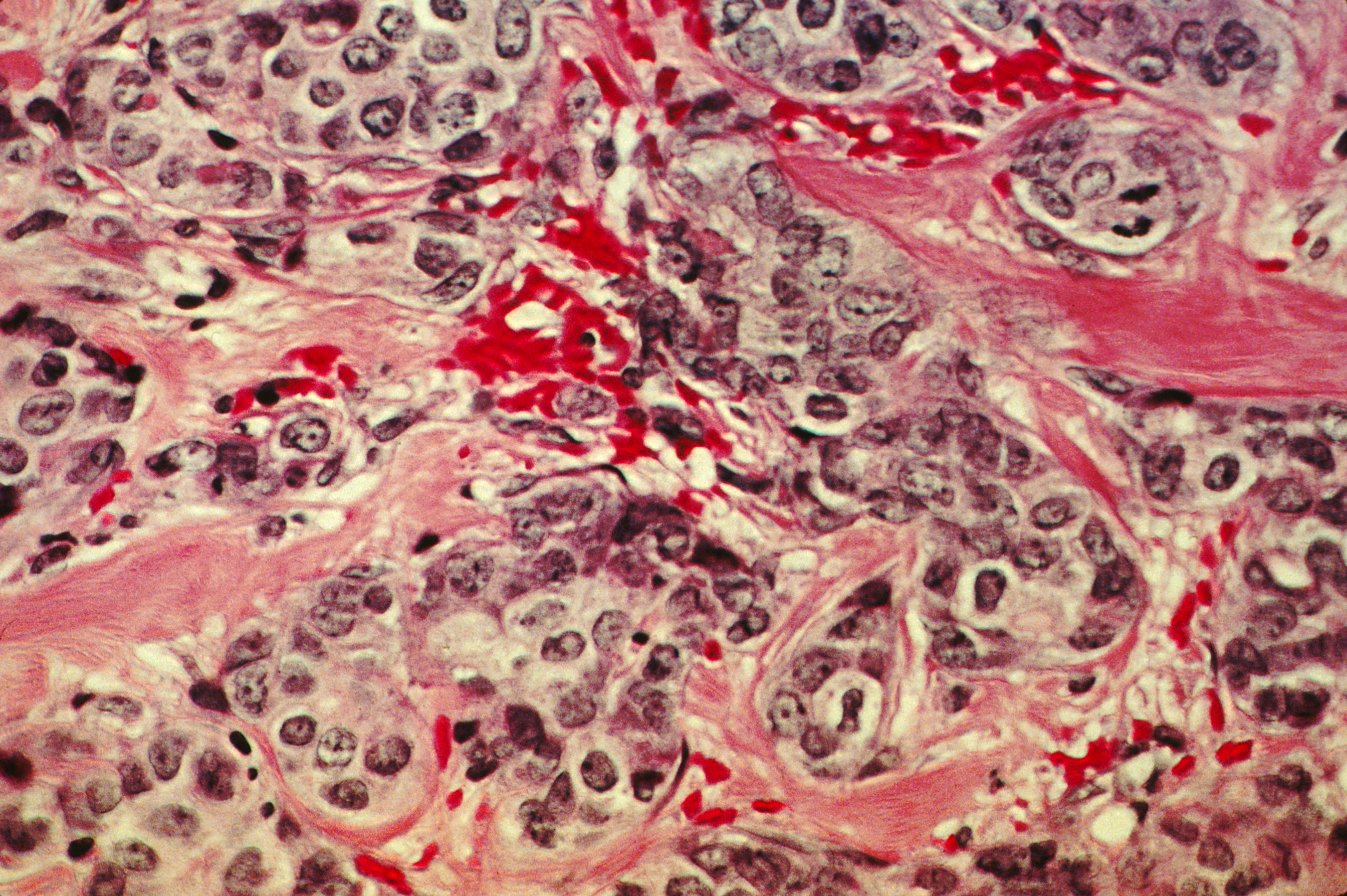A histological slide of cancerous breast tissue showing pink normal tissue pathways surrounding denser purple clusters of malignant cells.