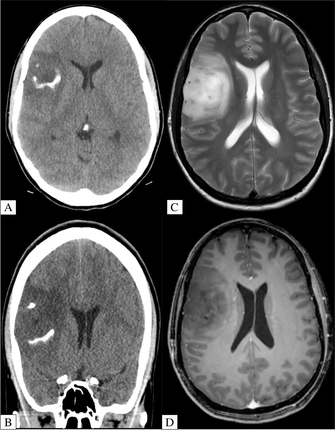 A grid of grayscale CT and MRI brain scans showing a lesion in the right frontal lobe, labeled A through D.
